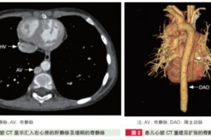 侧开胸不断跳施行肝静脉-奇静脉衔接术阜外医院闫军团队巧治杂乱先心病