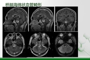 脑干海绵状血管瘤需求手术医治吗能打伽玛刀吗